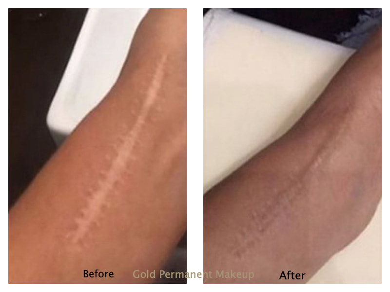 Camouflage Scar and Stretch Mark Tattoo. Scars, tummy tuck, surgical scars,  lipo scars, breast lift scars, stretch marks. Brazilian camouflage tattoo  Utah by Meagan Chapman